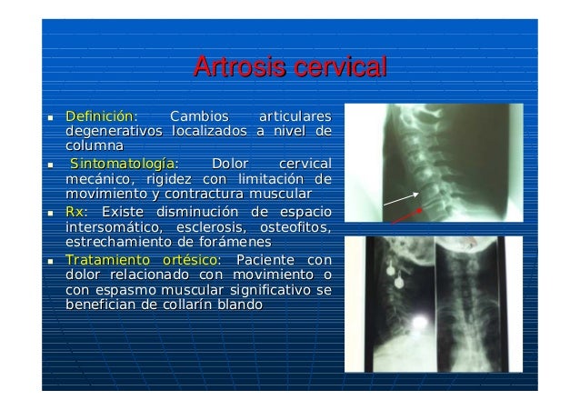artrodesis definicion